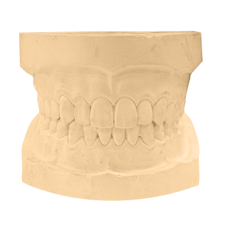 Casts  Visualize your treatments better with digital reproductions of your patient's teeth and mounted on the Panadent Articulator.	      Casts  Facial Reference Digital Mounting Models Facial reference digital mounting models are a faster, more convenient solution to the traditional models made and mounted with stone. With just your scans and records, you will receive a model with the prefabricated Panadent attachment that allows the models to "click" on to the Kois Digital Transfer Adapter which is used to attach digitally mounted casts onto the Panadent Articulator.  What you need:   Clean STLs: Maxillary Scan Mandibular Scan Bite Scan BSTL adapters from Panadent* Full face retracted with facial reference glasses     *The adaptors can be ordered online or by phone for $429 USD. If you are calling by phone, please call Panadent directly at (909) 783-1841 or (800) 368-9777 in U.S. & Canada.  What you get:  - Downloadable STL files of the upper and lower arches with attachments      Hinged Mounted Model  What you need: - Clean STL files: - Maxillary Scan - Mandibular Scan - Bite Record Scan  What you get: - A downloadable STL file of a printable STL file with an attachment     Learn More