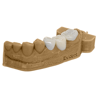 Crown & Bridge  Fixed prosthetics that are used to replace your patient's damaged or missing teeth.      Crown & Bridge  Crowns and bridges are fixed prosthetic restorations. Unlike removable devices such as dentures that can be taken out and cleaned daily; crowns and bridges are cemented onto existing teeth or implants.  What we need:   Clean STL scans: upper, lower and bite   What you will get:  STL file of a completed crown and/or bridge design   Learn More